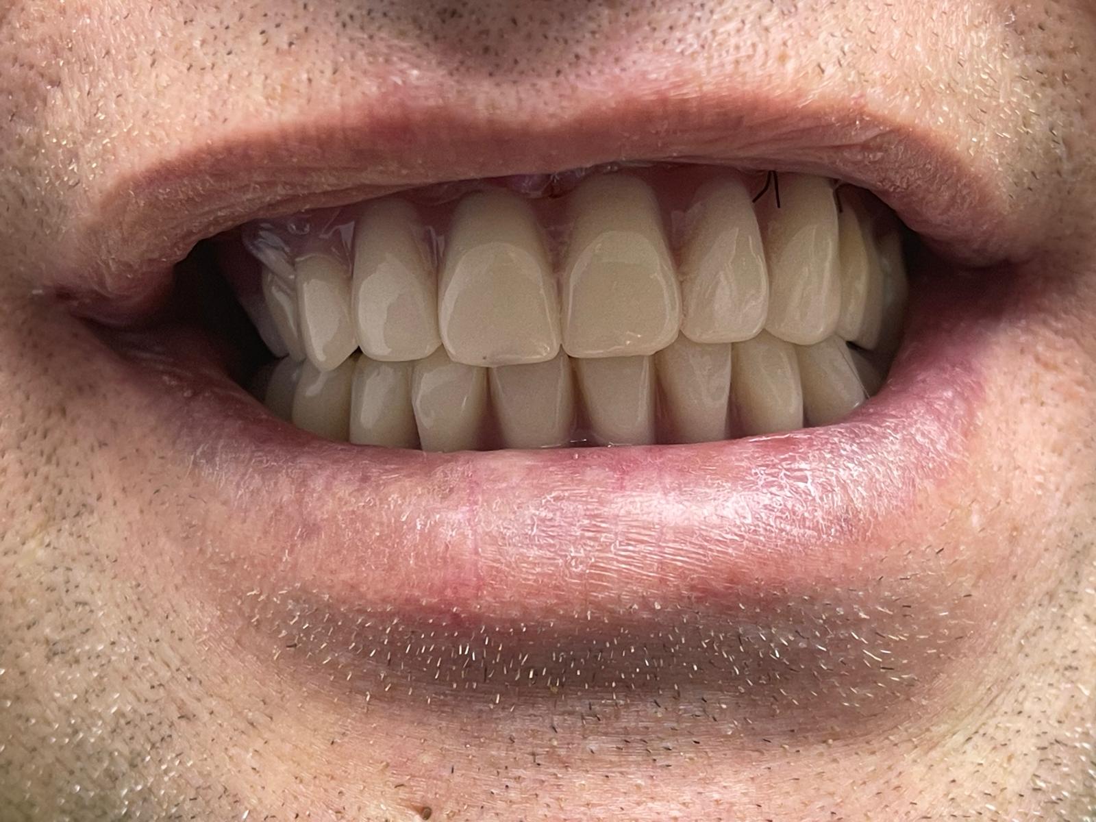 Dantură fixă finală pe arcada inferioară - dinți ficși în 24 de ore Denta Fast