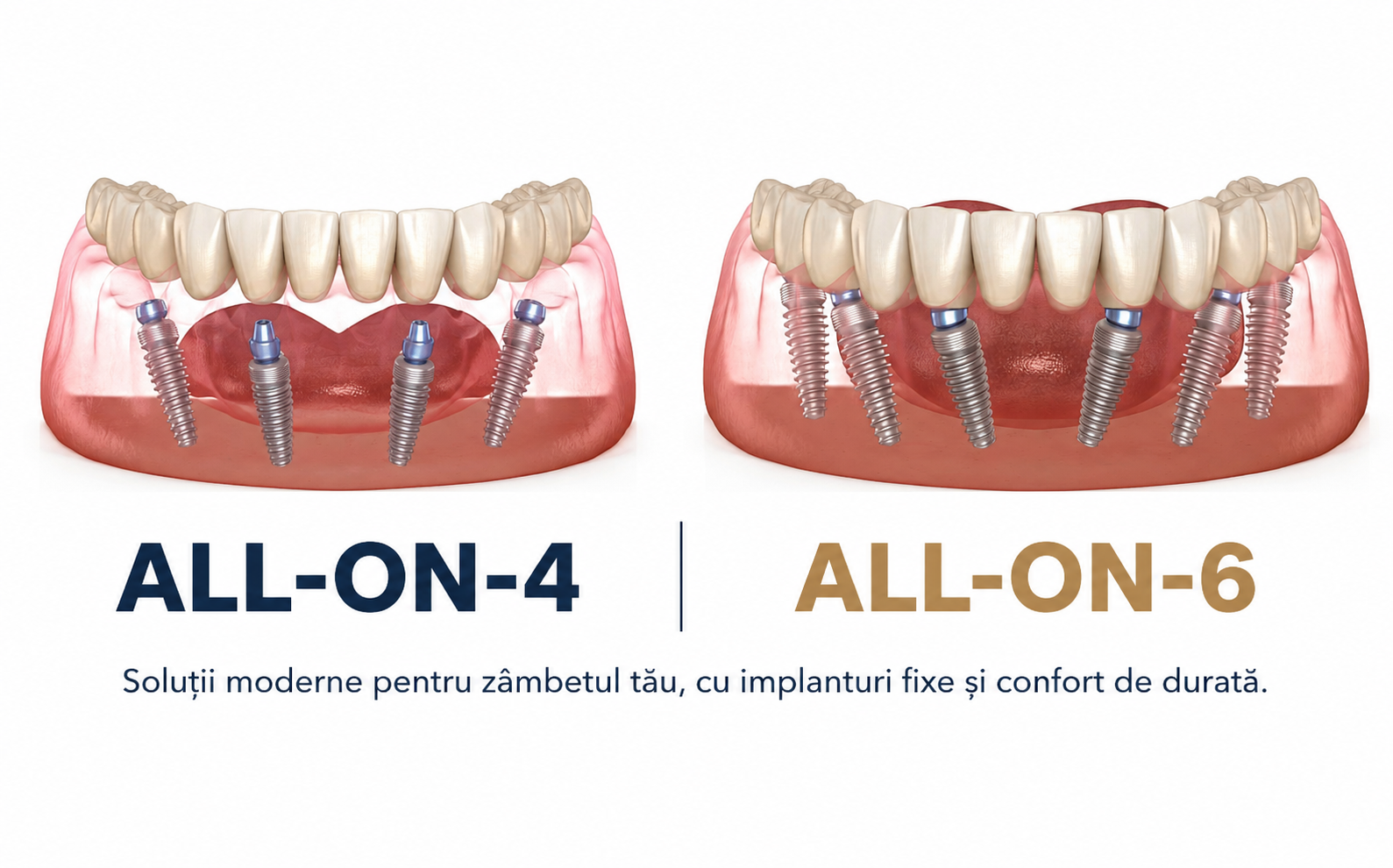 Dantură fixă pe arcada superioară - dinți ficși în 24 de ore Denta Fast